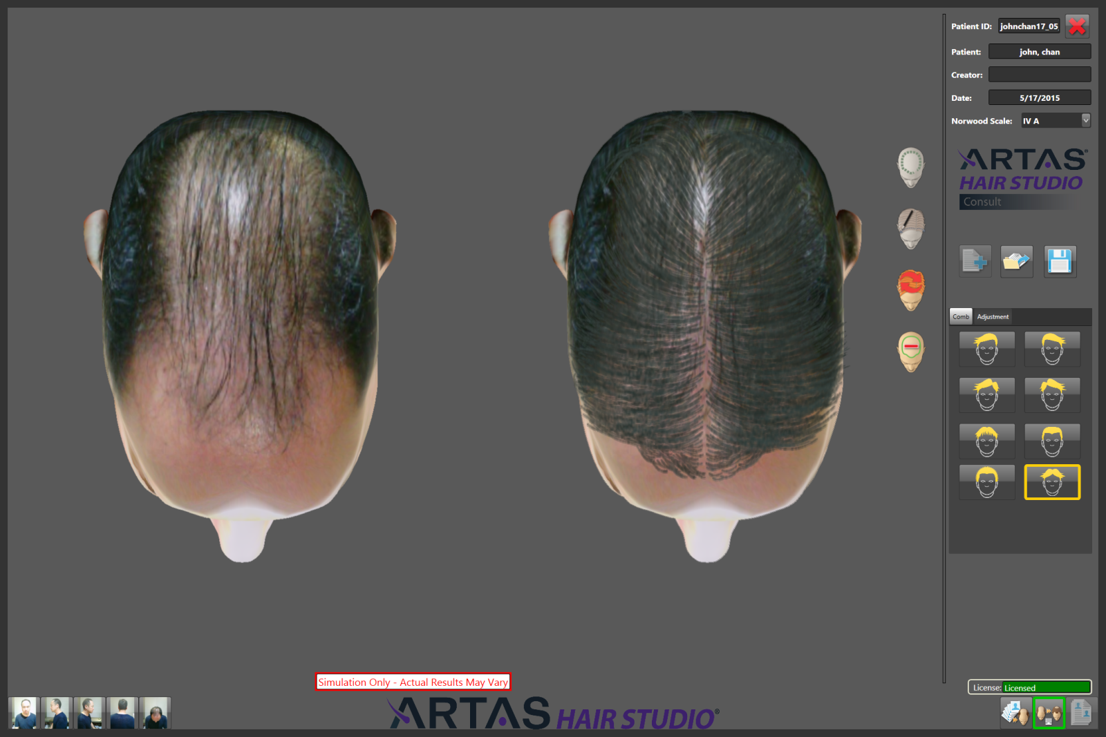 植髮,植髮機器人